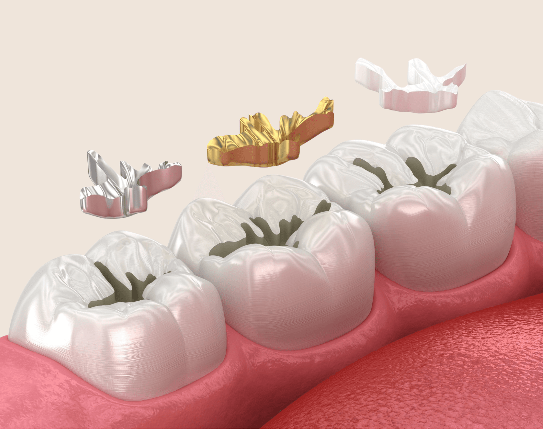 Dental Fillings 2