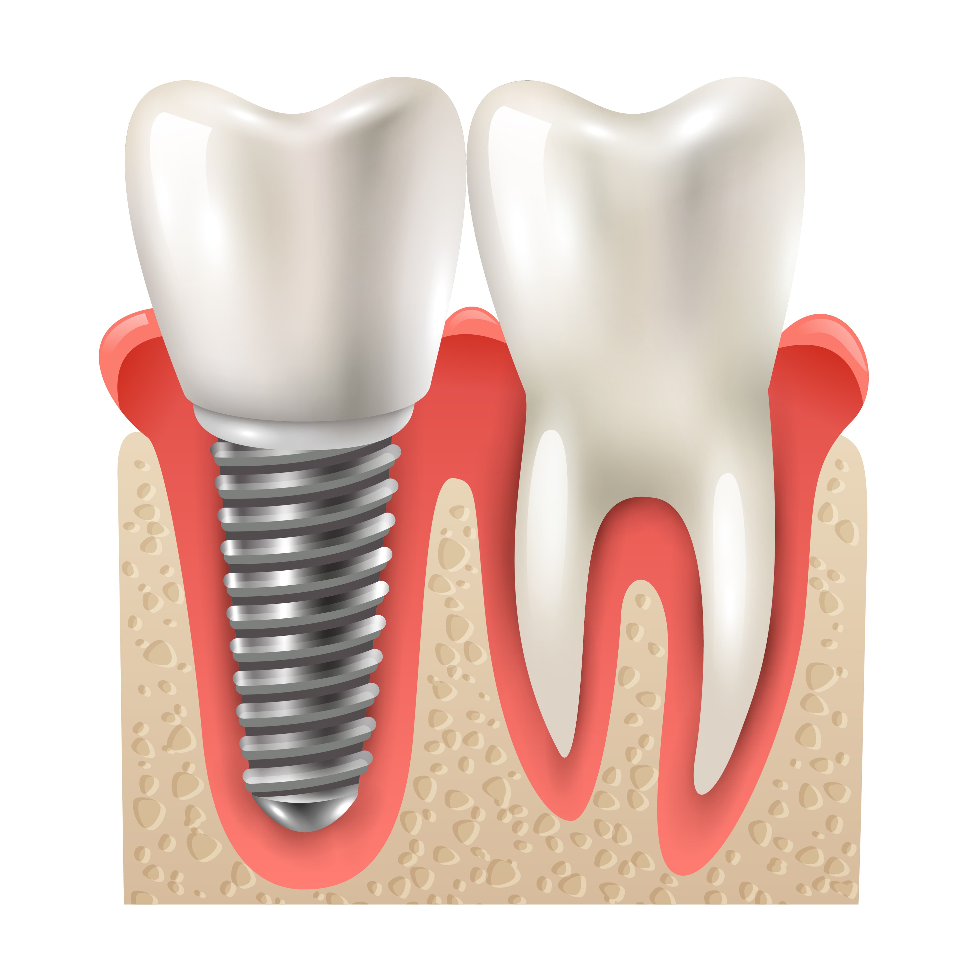 Dental Implants and All-on-4 in NYC: A Practical Guide to Permanent Tooth Replacement