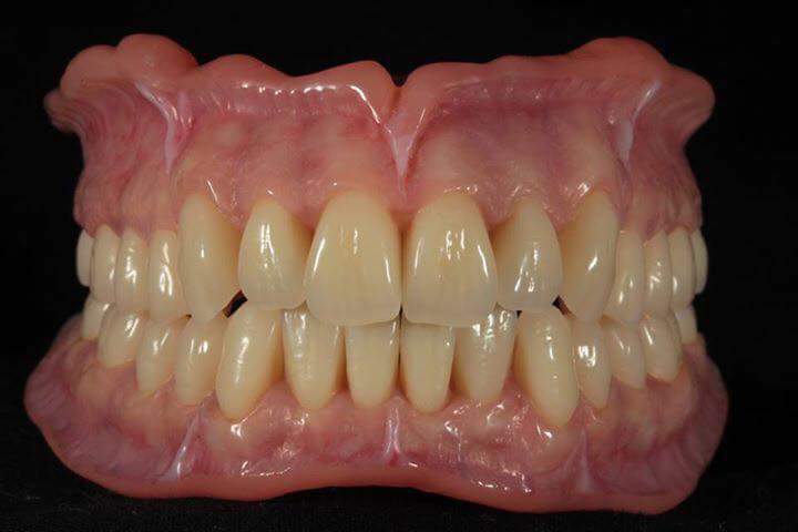Custom Esthetic Denture