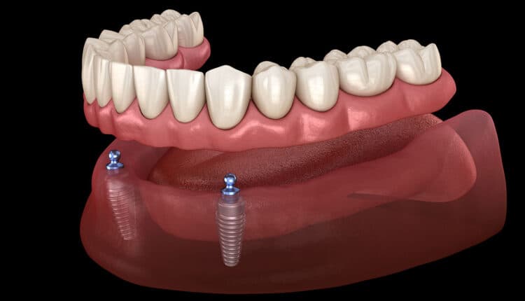 overdenture