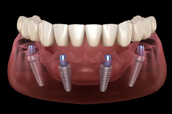 all on 4 dental implants 2103
