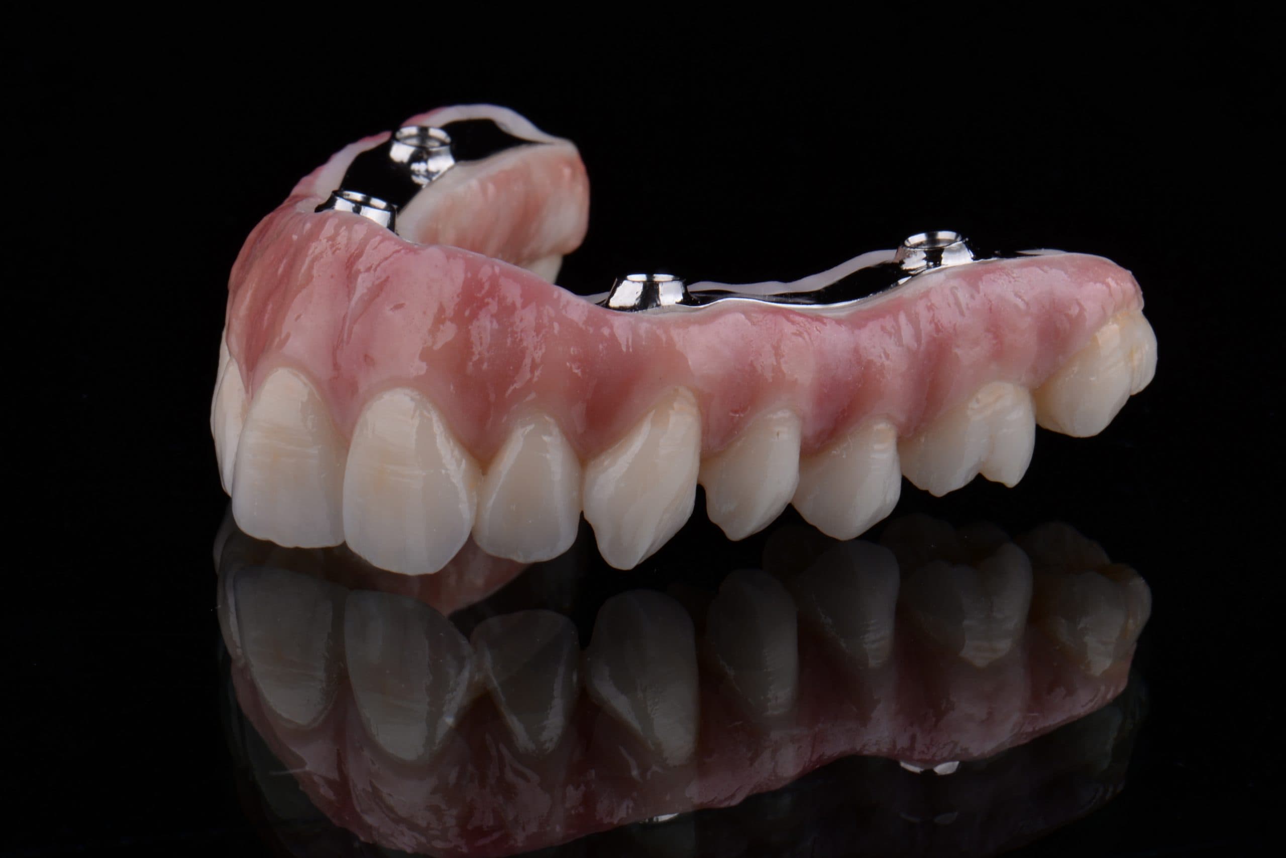 All of 4 Zirconia Hybrid Prosthesis