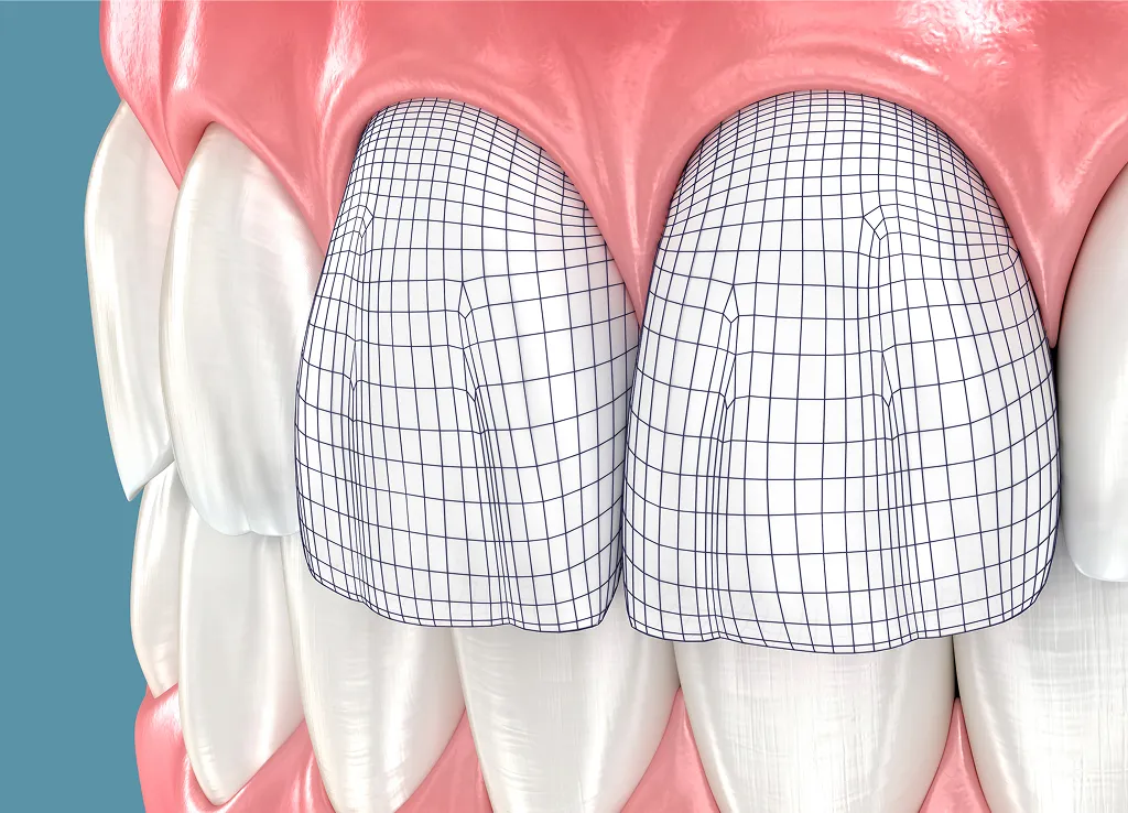Close-up of human upper front teeth with an overlay grid illustrating the shape and contour of the two central incisors.